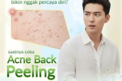 Insecure Karena Jerawat Punggung?